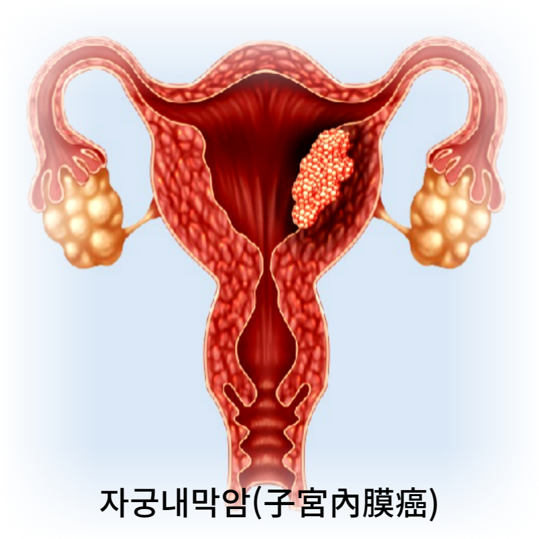 자궁내막암 초기 증상, 자궁내막암 증가 원인