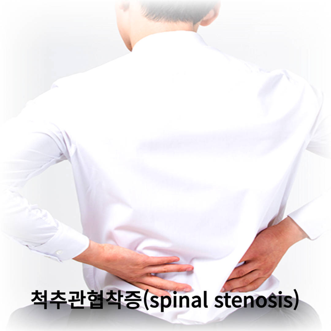 척추 건강 지키는 습관, 척추관협착증 운동